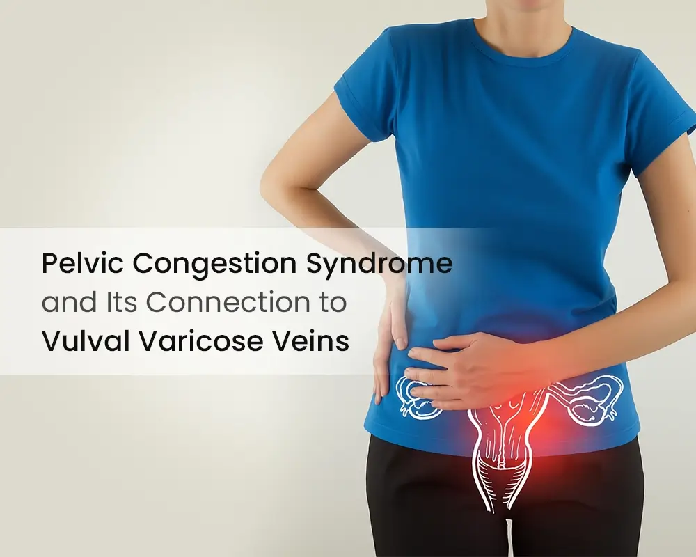 Pelvic Congestion Syndrome and Its Connection to Vulval Varicose Veins