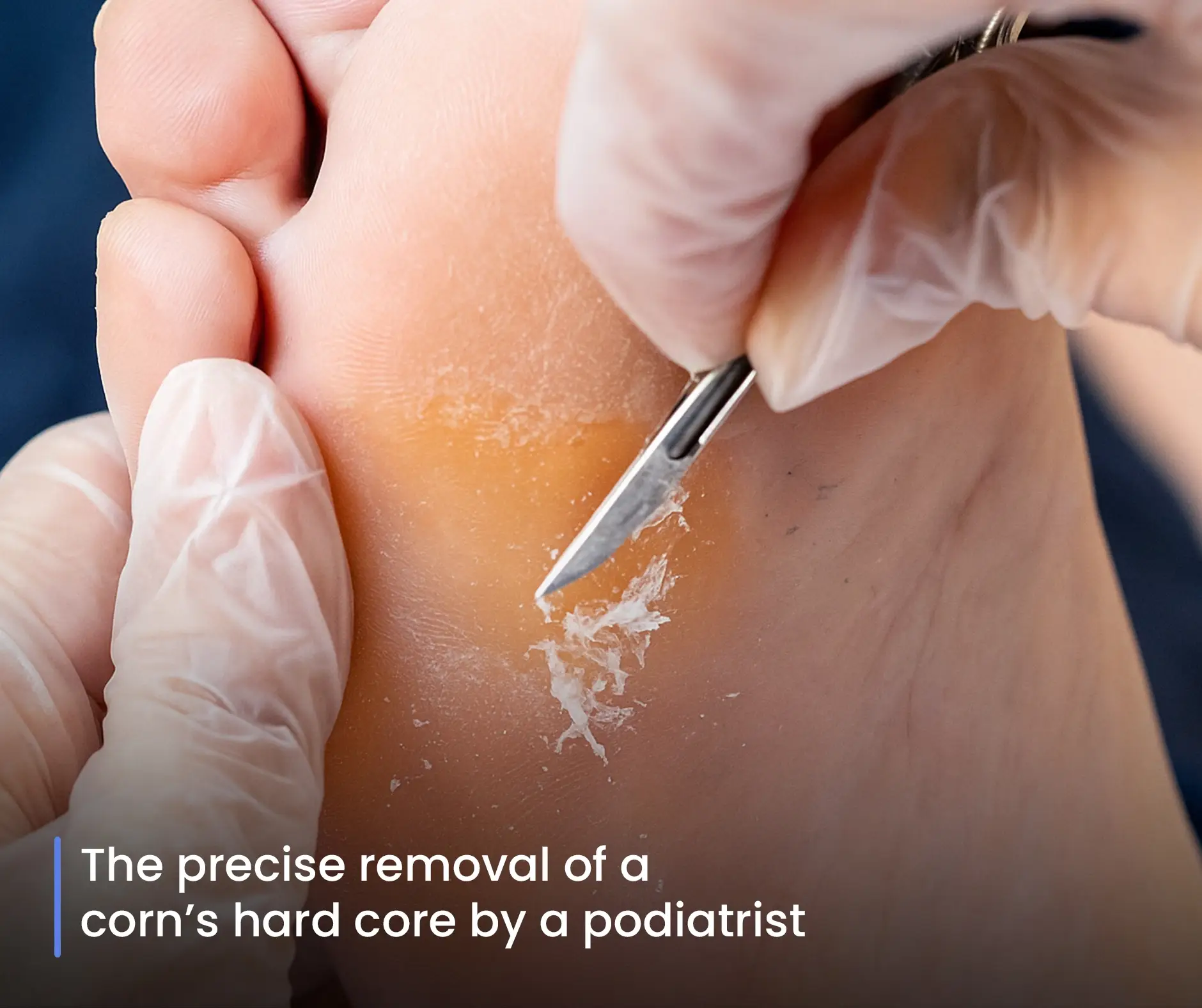The precise removal of a corn's hard core by a podiatrist