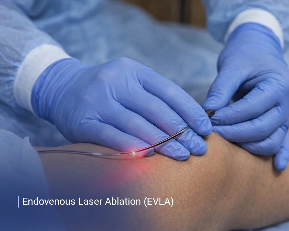 Endovenous Laser Ablation (EVLA)