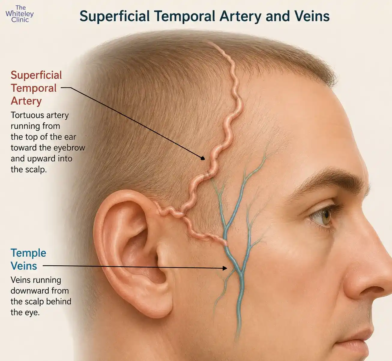 Superficial temporal arteries (temple arteries)