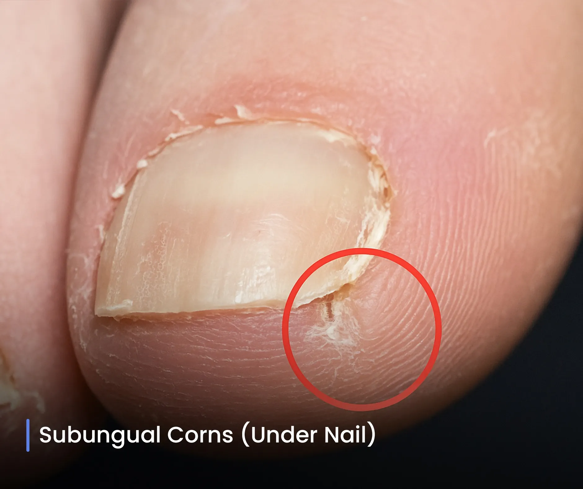 Subungual Corns (Under Nail)