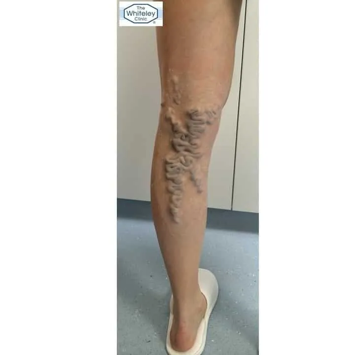 Amazing make up to look like Varicose Veins by Emma Croft - make up artist for Blue Roses - a Marianna Simnett Film at The Whiteley Clinic 27 June 2015