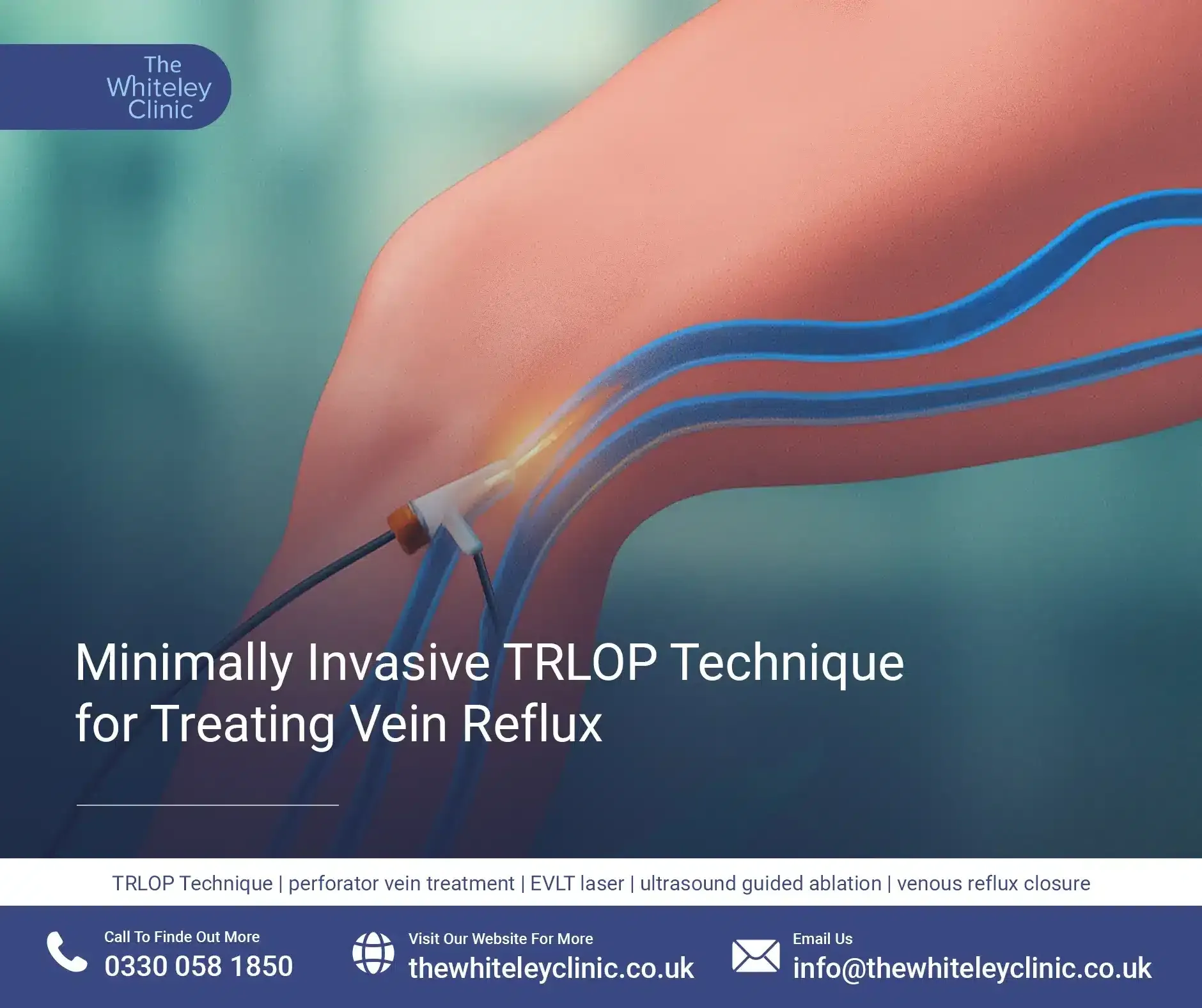 Minimally Invasive TRLOP Technique for Treating Perforator Vein Reflux