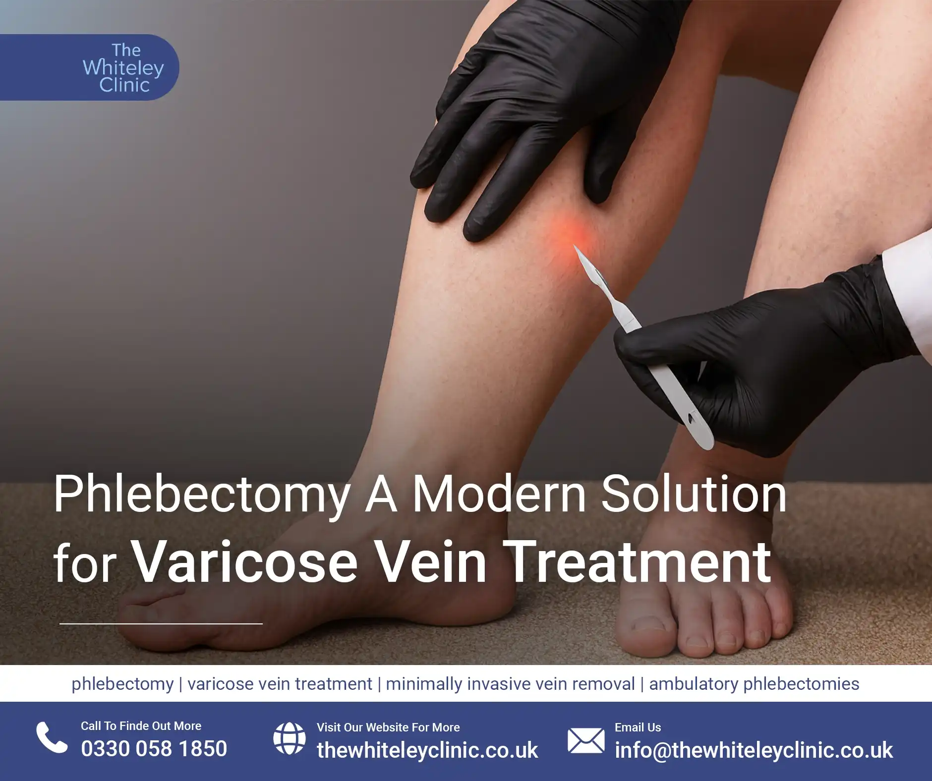 phlebectomy A Modern Solution for Varicose Vein Treatment