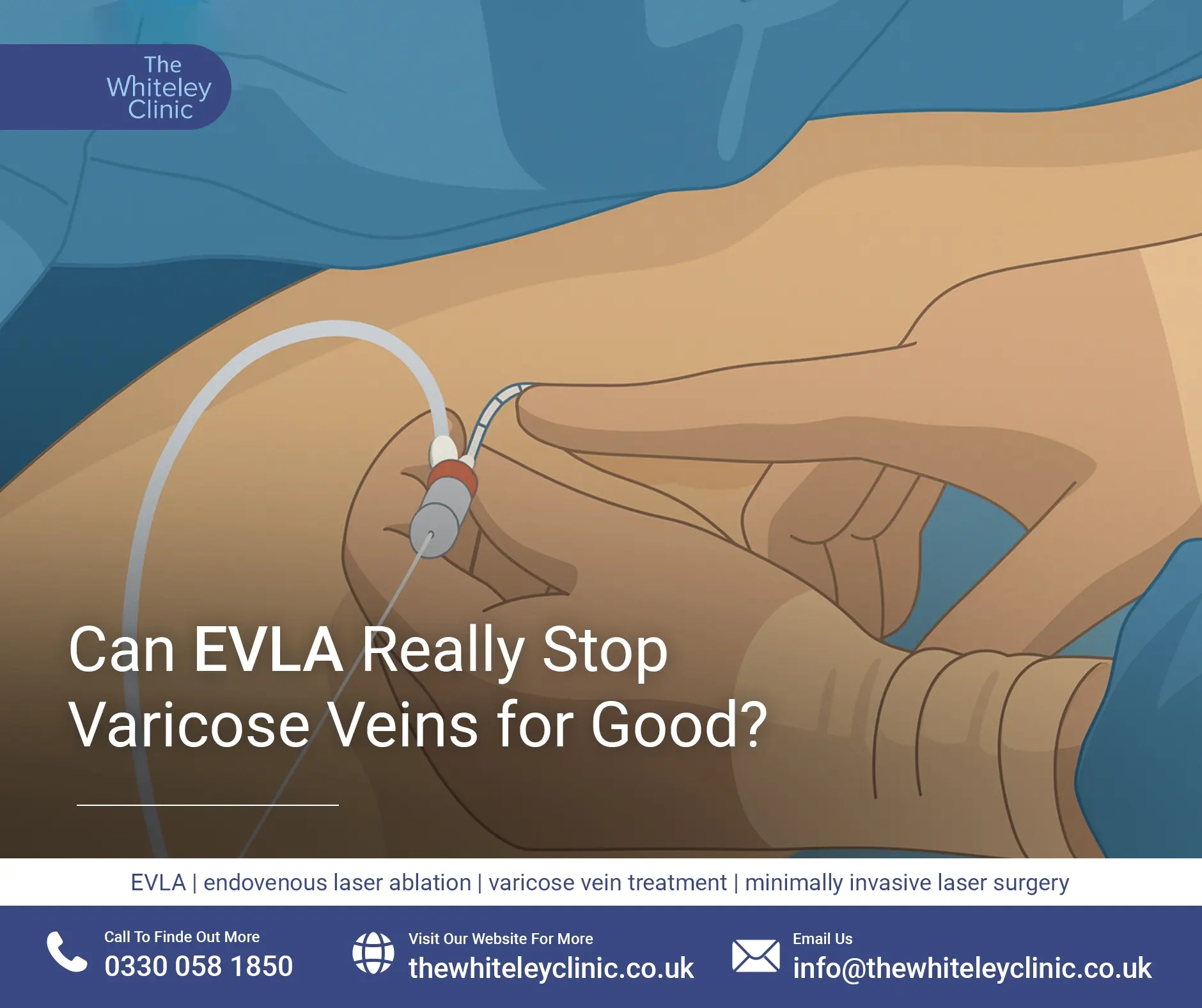 Can EVLA Really Stop Varicose Veins for Good?