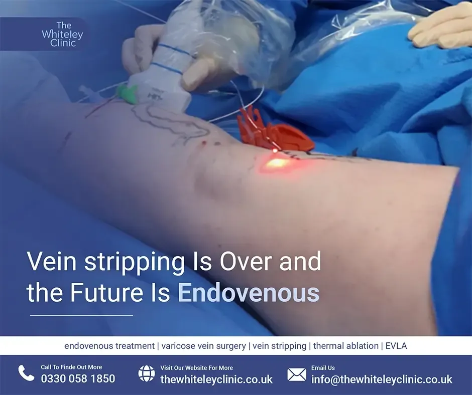 Vein stripping Is Over and the Future Is Endovenous