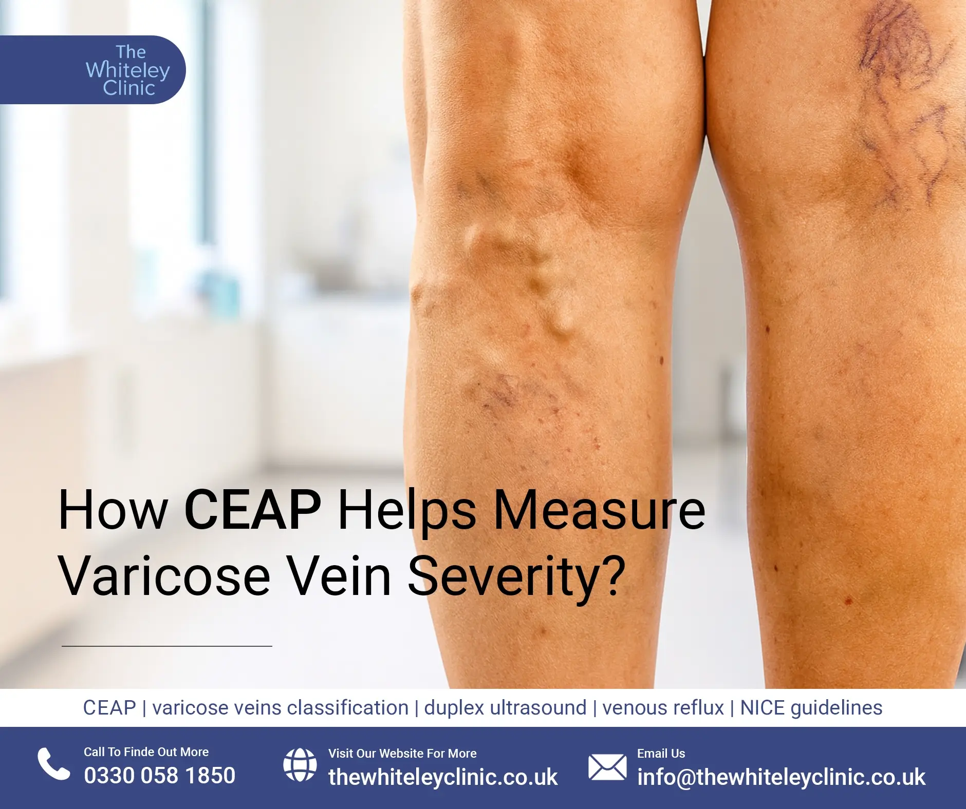 How CEAP Helps Measure Varicose Vein Severity?
