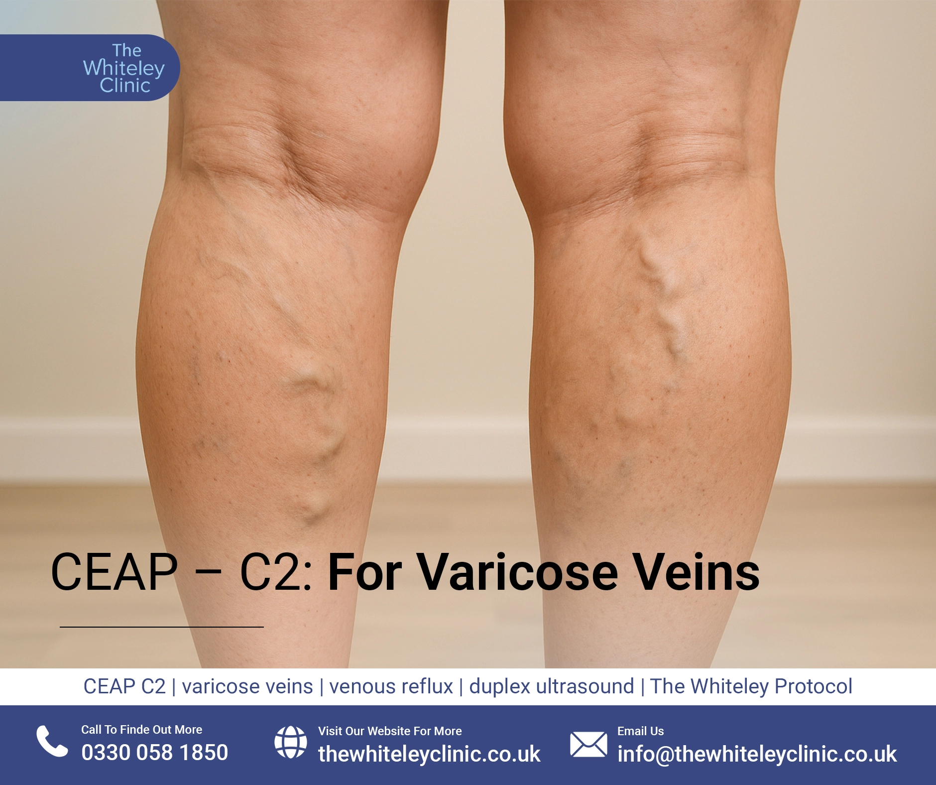 CEAP – C2: For Varicose Veins